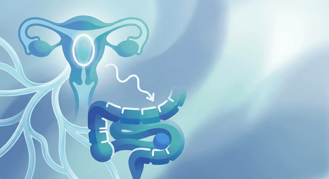 Constipation in uterine cancer treatment: causes and care